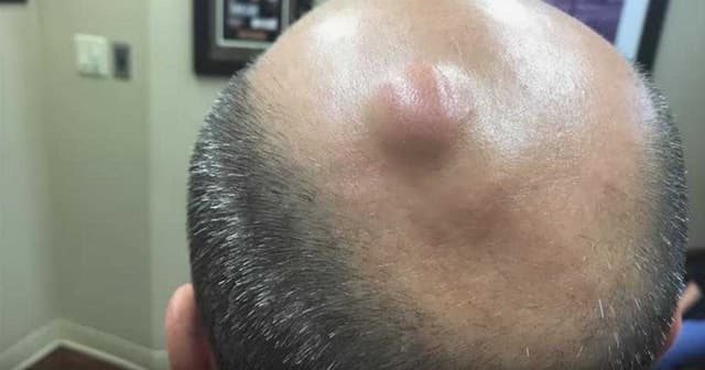 Epidermoid kistalar
