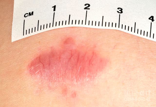 Teri fibromalari (dermatofibromalar)