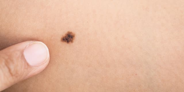Melanoma