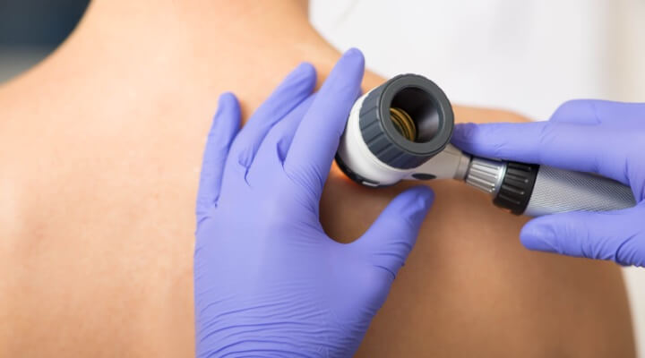 Dermatoskop yordamida tekshirish (Noinvasive)