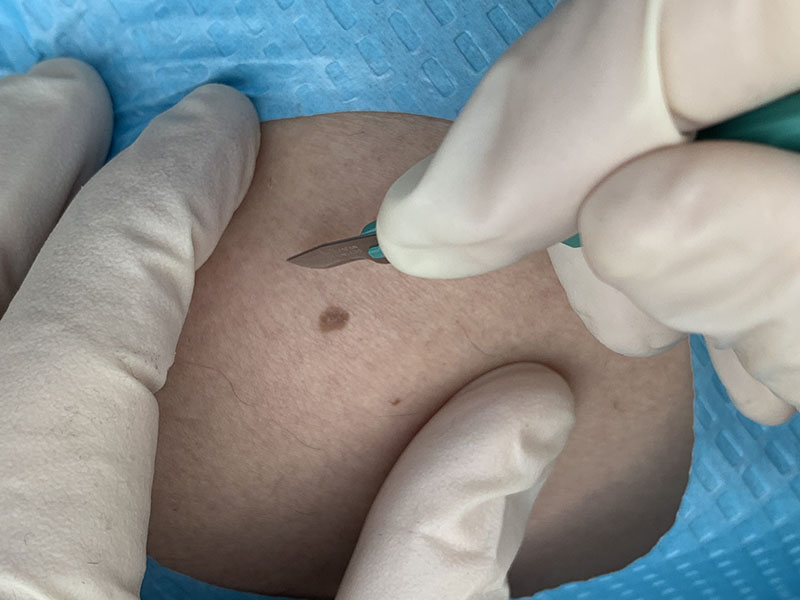 Biopsiyalar (invaziv)